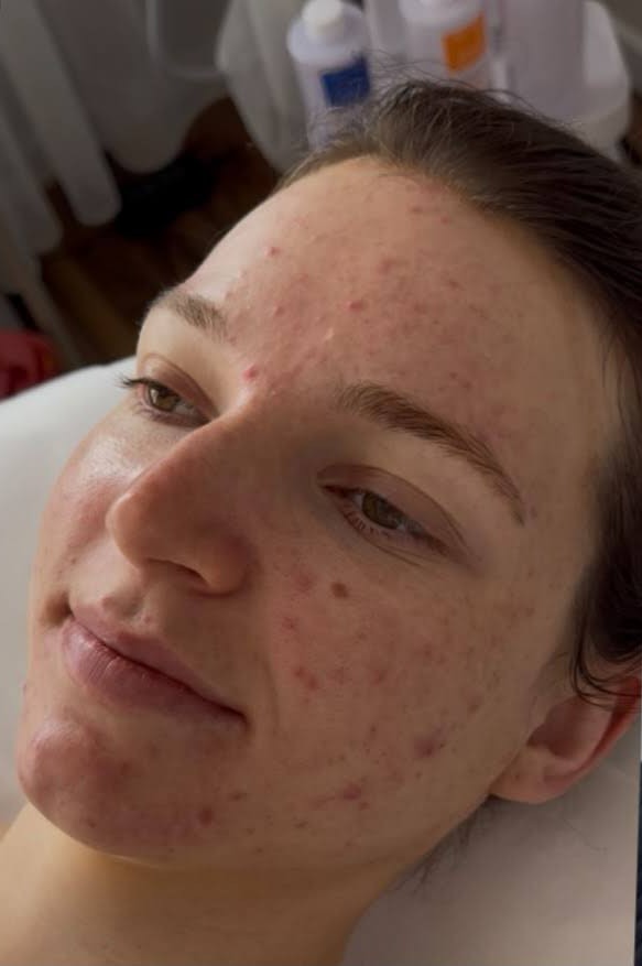 Gesicht einer jungen Frau vor der Behandlungsreihe mit stark ausgeprägten Unreinheiten auf Stirn und Wangen