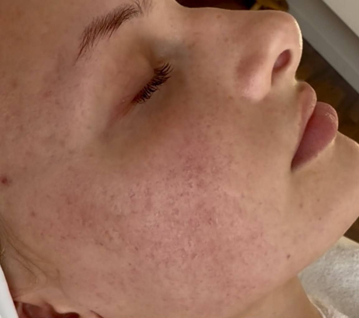 Nahaufnahme einer Wange vor der Behandlung: unebenes Hautbild mit vielen kleinen Unreinheiten und Rötungen